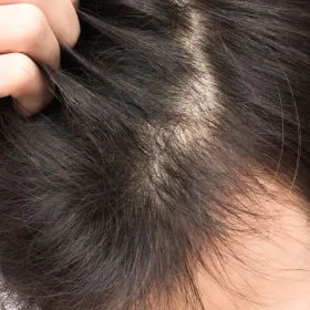 薄毛